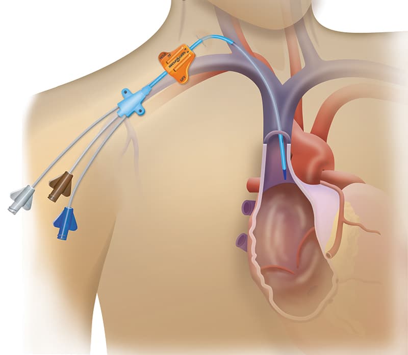 SecurAcath placement illustration